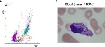 Case report: Hemophagocytic lymphohistiocytosis in a child with primary immunodeficiency infected with Talaromyces marneffei